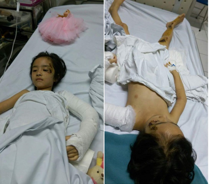 Bé Quản Thị Hiền Minh với nhiều chấn thương nằm trên giường bệnh. (Ảnh: FB Thao Luong)