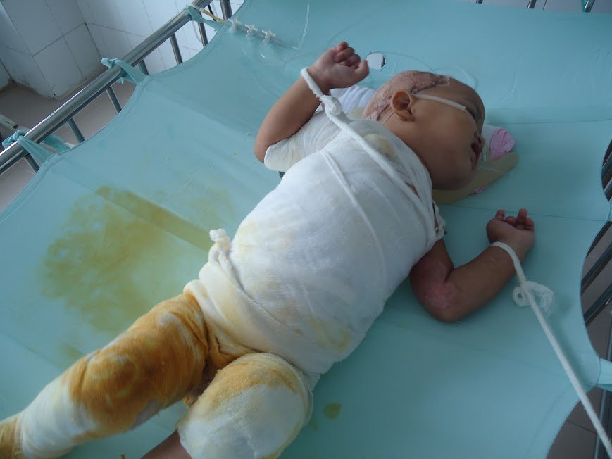 Giao Thủy: Ngã vào nồi canh nóng, bé gái 17 tháng tuổi nguy kịch