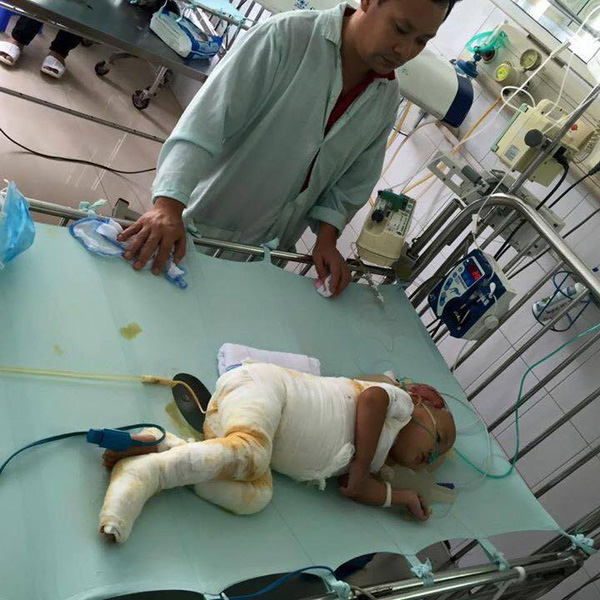 Đau xót: Bé gái 21 tháng tuổi ở Nam Định ngã vào nồi canh 25 lít, bỏng nặng toàn thân