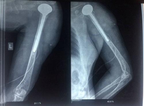 Hình ảnh X-quang sau mổ thay khớp vai của bệnh nhân.