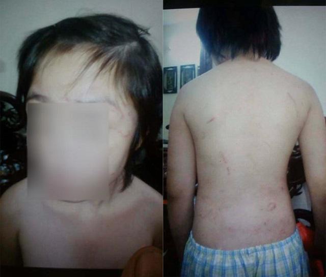 Bé trai 10 tuổi chằng chịt sẹo trên người: Bố đẻ thừa nhận đánh con