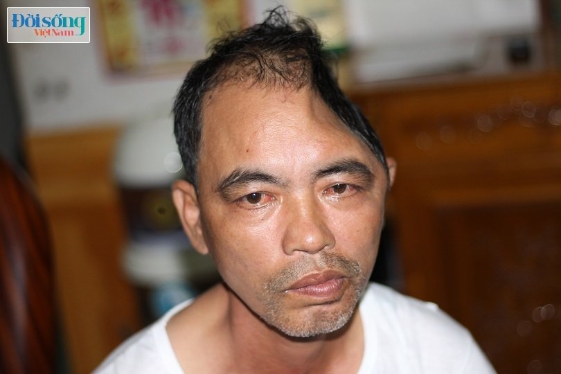 Nam Định: Người đàn ông mất một nửa hộp sọ sau vụ tai nạn giao thông kinh hoàng