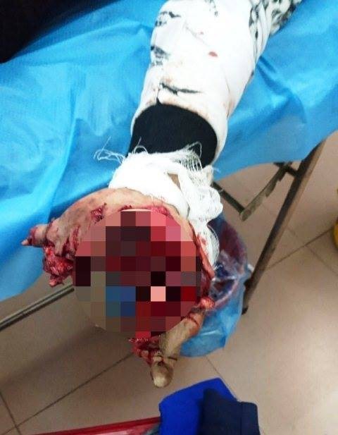 Nam Định: thanh niên 17 tuổi bị mất chức năng bàn tay vĩnh viễn vì điện thoại phát nổ