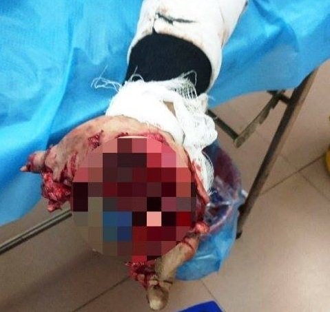 Nam Định: Thiếu niên 17 tuổi bị nát bàn tay vì điện thoại phát nổ