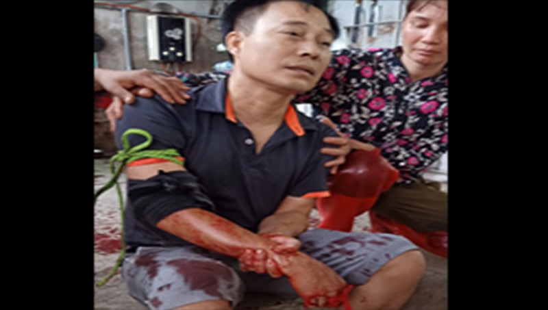 Vụ truy sát gây thương tích nghiêm trọng ở Giao Thủy (Nam Định): Nạn nhân đang chờ kết quả giám định tỷ lệ tổn thương cơ thể