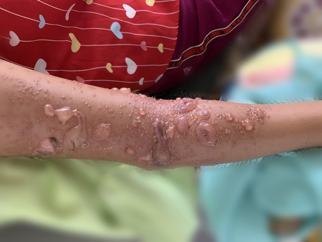 Bé gái 8 tuổi bị sứa cắn phải nhập viện