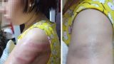 Xác minh thông tin cô giáo đánh học trò tím tay do viết bài chậm