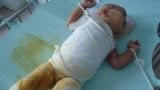 Giao Thủy: Ngã vào nồi canh nóng, bé gái 17 tháng tuổi nguy kịch