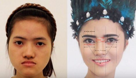 Cô gái Nam Định ‘vịt hóa thiên nga’ sau 8 tiếng dao kéo