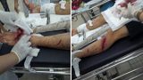 Nam Định: Hơn 10 côn đồ mang dao, kiếm chém người trọng thương