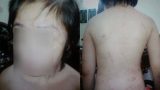 Bé trai 10 tuổi chằng chịt sẹo trên người: Bố đẻ thừa nhận đánh con