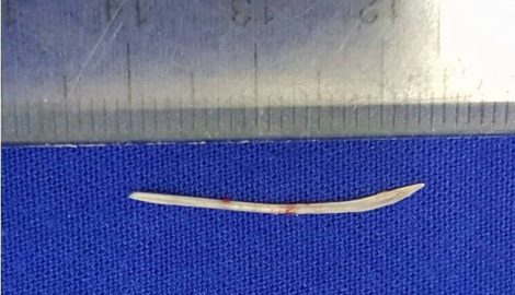 Xương cá đâm xuyên thực quản gây áp xe tuyến giáp