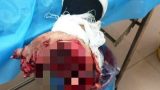 Nam Định: thanh niên 17 tuổi bị mất chức năng bàn tay vĩnh viễn vì điện thoại phát nổ