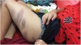 Thi không đạt 95 điểm, bé trai bị mẹ đánh đập dã man khiến toàn thân bầm tím