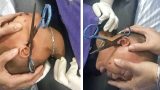 Cha mẹ lơ là, bé trai 2 tuổi bị kéo cắm ngập vào tai