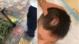 Bé trai phải nhập viện vì bị chổi lau nhà ở chung cư cao cấp rơi trúng đầu