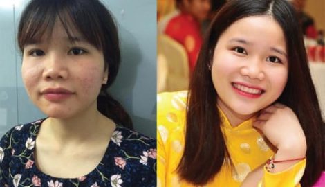 Nữ sinh Nam Định “vịt hóa thiên nga” chỉ sau 2 tháng