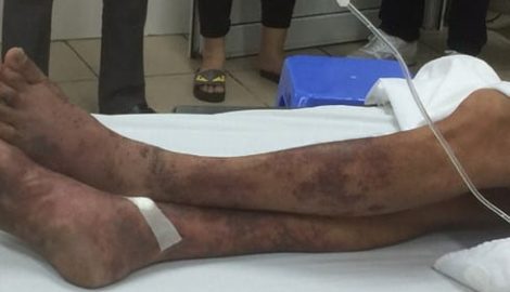 Nam Định: Ăn tiết canh, gần chục ca viêm màng não, hoại tử da vì liên cầu lợn