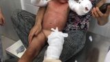 Hai cháu bé bỏng toàn thân sau khi đốt giấy để chơi
