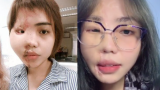 Cô gái bị chồng sắp cưới tạt axit biến dạng khuôn mặt: 16 cuộc phẫu thuật lớn nhỏ trong suốt gần 2 năm và diện mạo mới gây bất ngờ
