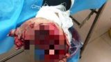 Nam Định: Thiếu niên 17 tuổi bị nát bàn tay vì điện thoại phát nổ