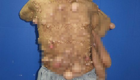 Người phụ nữ hơn 40 năm chung sống với hàng trăm khối u