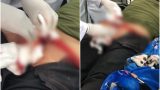 Ngồi xổm làm sập bồn cầu, nam thanh niên bị các mảnh sứ cứa rách phần mông sâu đến tận xương cụt
