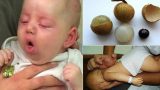 Bé gái Nam Định sống thực vật vì vừa đùa vừa ăn nhãn, BV Nhi Trung ương không thể chữa trị