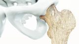 Di chứng mới làm chết tế bào xương ở bệnh nhân Covid-19
