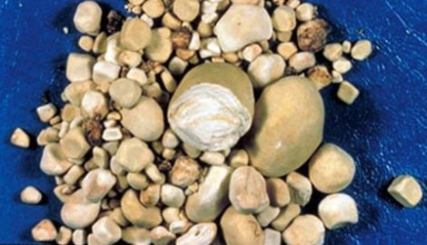 Mất thận vì detox theo phương pháp “bác sĩ google”